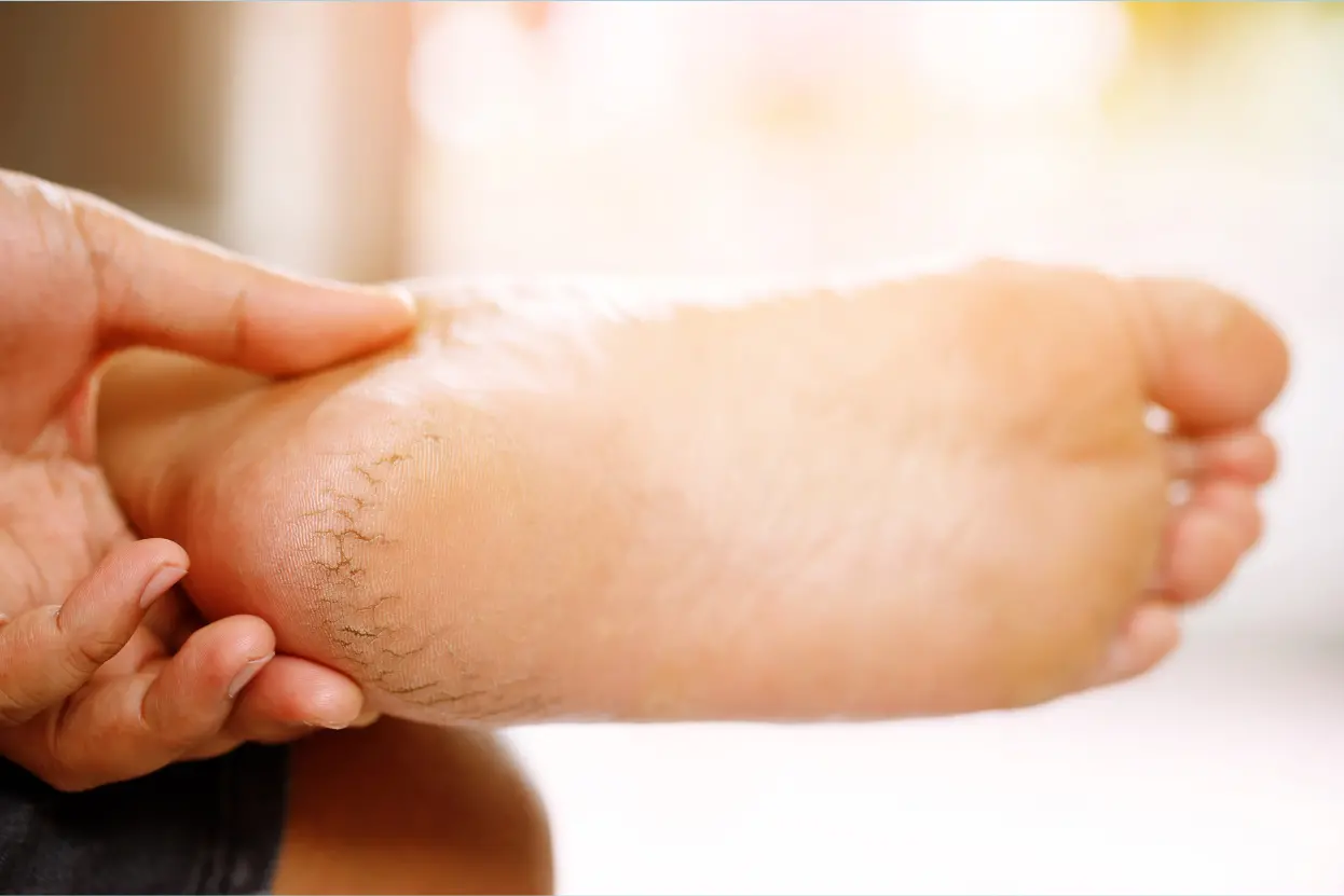 শীতে পায়ের গোড়ালি ফাটা রোধ করার উপায়