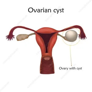 ওভারিয়ান সিস্ট কি, কাকে বলে