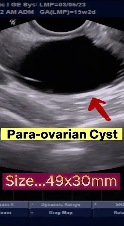 ওভারিয়ান সিস্ট কী