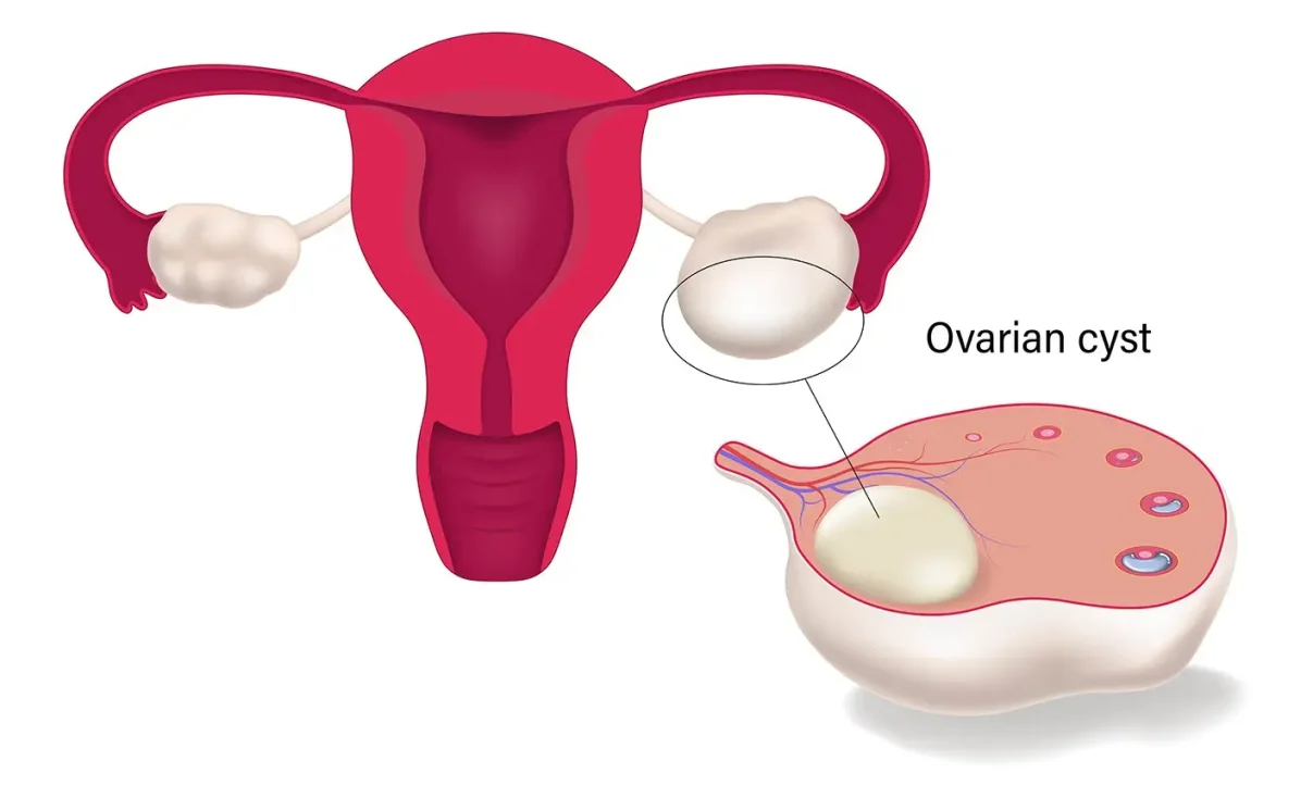 ওভারিয়ান সিস্ট কেন হয়