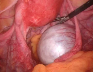 ওভারিয়ান সিস্ট দূর করার উপায়