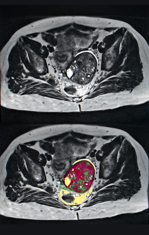 ওভারিয়ান সিস্টের চিকিৎসা