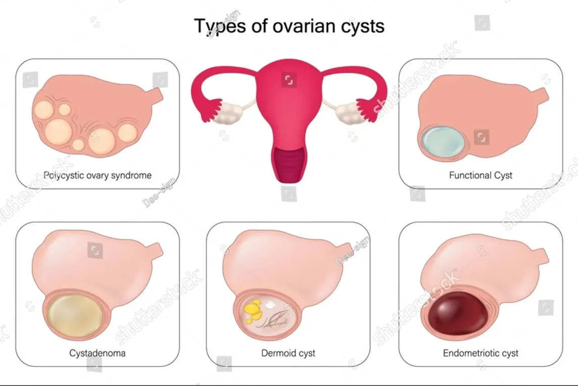 ওভারিয়ান সিস্টের প্রকারঃ ওভারিয়ান সিস্ট কত প্রকার হয়