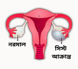 ওভারিয়ান সিস্টের লক্ষণ