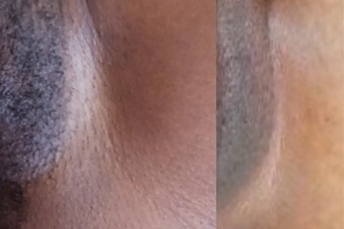 মেয়েদের যোনিপথ কালো হয় কেন, কারণ, সমাধান ও ঘরোয়া উপায়