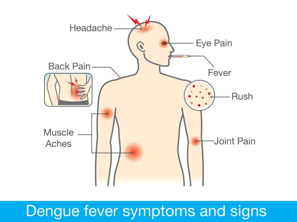 Image of dengue fever skin rash~Dengue Fever: What to Do and What Not to Do for Effective Management~ইনফরমেশন বাংলা ডটকম~informationbangla.com