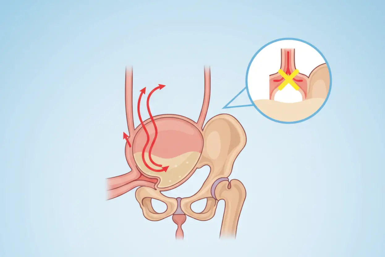 বীর্য বাহির হয় না বা রেট্রোগ্রেড ইজাকুলেশন কী, বীর্য বাহির না হবার কারণসমূহ