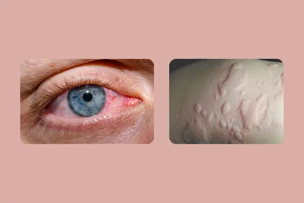 এলার্জি কি, এলার্জি কেন হয়, এলার্জি চিরতরে দূর করার উপায়