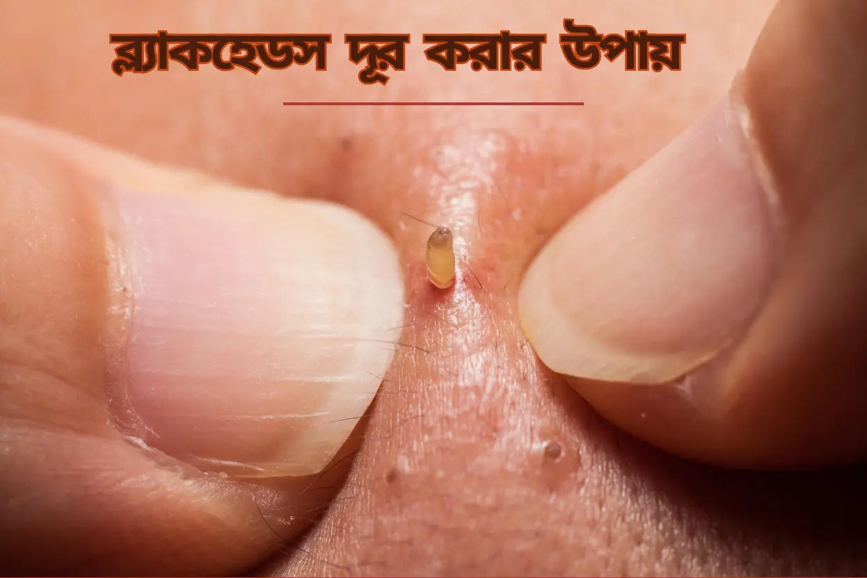 ব্ল্যাকহেডস দূর করার উপায়~ব্ল্যাকহেডস দূর করার উপায়~InformationBangla.com~Information Bangla Dotcom